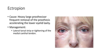 Ectropion
• Cause: Heavy large prosthesisor
frequent removal of the prosthesis
accelerating the lower eyelid laxity.
• Management:
• Lateral tarsal strip or tightening of the
medial canthal tendon.
 