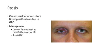 Ptosis
• Cause: small or non-custom
fitted prosthesis or due to
GPC.
• Management:
• Custom fit prosthesis to
modify the superior lift.
• Treat GPC
 