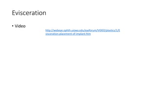 Evisceration
• Video
http://webeye.ophth.uiowa.edu/eyeforum/VIDEO/plastics/1/E
visceration-placement-of-implant.htm
 