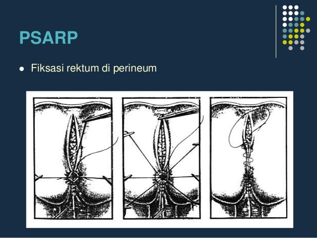 Anoplasty
