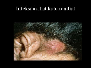 Infeksi akibat kutu rambut
 