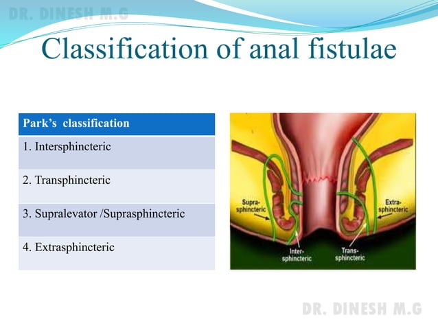 Anorectal abscess & Anal fistulae | PPTX | Digestive Disorders ...