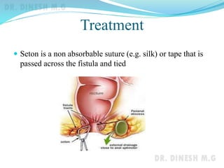 Anorectal abscess & Anal fistulae | PPTX