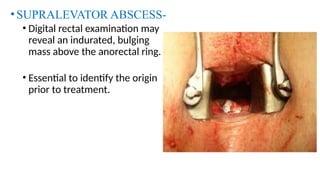 HDTV sucks just ANORECTAL ABSCESSES.pptx
