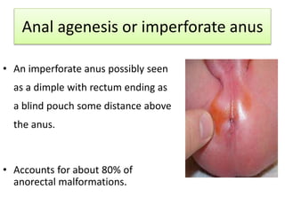 Anal agenesis or imperforate anus
• An imperforate anus possibly seen
as a dimple with rectum ending as
a blind pouch some distance above
the anus.
• Accounts for about 80% of
anorectal malformations.
 