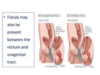 • Fistula may
also be
present
between the
rectum and
urogenital
tract.
 