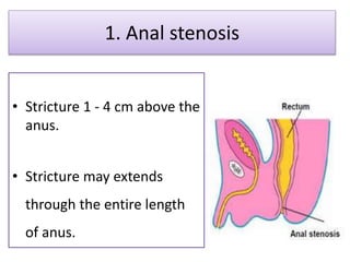 1. Anal stenosis
• Stricture 1 - 4 cm above the
anus.
• Stricture may extends
through the entire length
of anus.
 