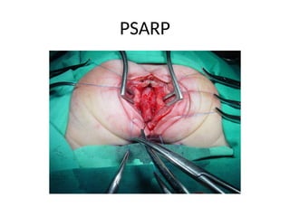 Anorectal anomalies_12434_SURG-T_11-12-2024.ppt