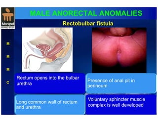 MALE ANORECTAL ANOMALIES 
Rectobulbar fistula 
M 
M 
M 
C 
Rectum opens into the bulbar 
urethra 
Presence of anal pit in 
perineum 
Long common wall of rectum 
and urethra 
Voluntary sphincter muscle 
complex is well developed 
 