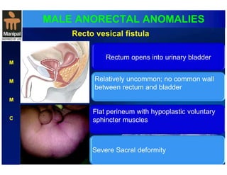 MALE ANORECTAL ANOMALIES 
M 
M 
M 
C 
Recto vesical fistula 
Rectum opens into urinary bladder 
Relatively uncommon; no common wall 
between rectum and bladder 
Flat perineum with hypoplastic voluntary 
sphincter muscles 
S evere Sacral deformity 
 
