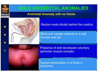 MALE ANORECTAL ANOMALIES 
M 
M 
M 
C 
Anorectal Anomaly with no fistula 
Rectum ends blindly behind the urethra 
Blind end usually extends to a well 
formed anal pit 
Presence of well developed voluntary 
sphincter muscle complex 
T ypical presentation in a Down’s 
syndrome 
 