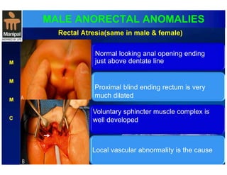 MALE ANORECTAL ANOMALIES 
M 
M 
M 
C 
Rectal Atresia(same in male & female) 
Normal looking anal opening ending 
just above dentate line 
Proximal blind ending rectum is very 
much dilated 
Voluntary sphincter muscle complex is 
well developed 
L ocal vascular abnormality is the cause 
 