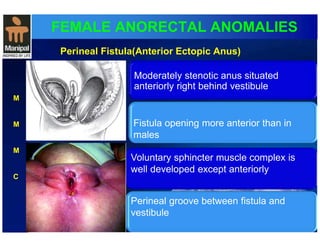 FEMALE ANORECTAL ANOMALIES 
M 
M 
M 
C 
Perineal Fistula(Anterior Ectopic Anus) 
Moderately stenotic anus situated 
anteriorly right behind vestibule 
Fistula opening more anterior than in 
males 
Voluntary sphincter muscle complex is 
well developed except anteriorly 
Perineal groove between fistula and 
v estibule 
 