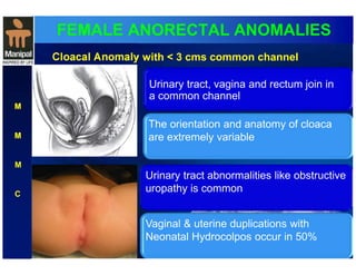 FEMALE ANORECTAL ANOMALIES 
M 
M 
M 
C 
Cloacal Anomaly with < 3 cms common channel 
Urinary tract, vagina and rectum join in 
a common channel 
The orientation and anatomy of cloaca 
are extremely variable 
Urinary tract abnormalities like obstructive 
uropathy is common 
Vaginal & uterine duplications with 
Neonatal Hydrocolpos occur in 50% 
 