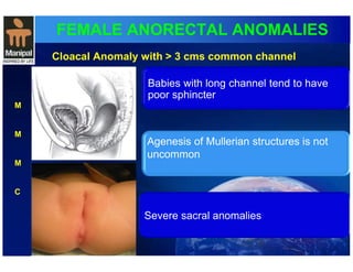 FEMALE ANORECTAL ANOMALIES 
M 
M 
M 
C 
Cloacal Anomaly with > 3 cms common channel 
Babies with long channel tend to have 
poor sphincter 
Agenesis of Mullerian structures is not 
uncommon 
Severe sacral anomalies 
 