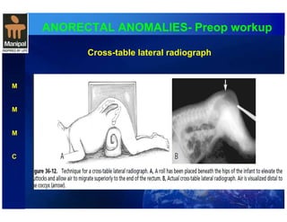 ANORECTAL ANOMALIES- Preop workup 
M 
M 
M 
C 
Cross-table lateral radiograph 
 