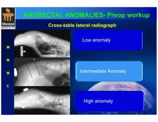 ANORECTAL ANOMALIES- Preop workup 
M 
M 
M 
C 
Cross-table lateral radiograph 
Low anomaly 
Intermediate Anomaly 
High anomaly 
 