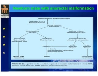 Newborn male with anorectal malformation 
M 
M 
M 
C 
 