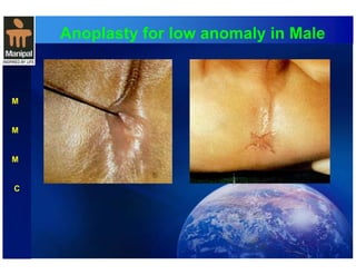 Anoplasty for low anomaly in Male 
M 
M 
M 
C 
 