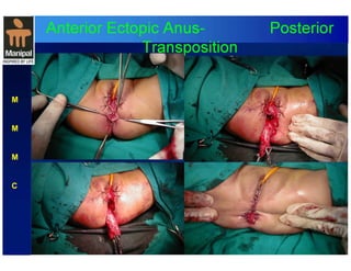 Anterior Ectopic Anus- Posterior 
Transposition 
M 
M 
M 
C 
 
