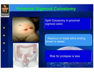 Proximal Sigmoid Colostomy 
M 
M 
M 
C 
Split Colostomy in proximal 
s ig m oid colon 
Washout of distal blind ending 
bowel is easier 
Risk for prolapse is less 
 