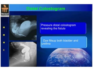 Distal Colostogram 
M 
M 
M 
C 
Pressure distal colostogram 
revealing the fistula 
Dye fillsup both bladder and 
urethra 
 