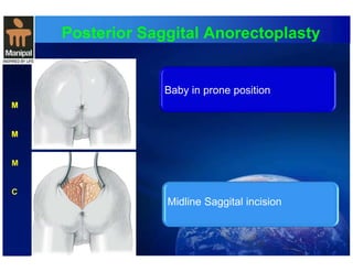 Posterior Saggital Anorectoplasty 
M 
M 
M 
C 
Baby in prone position 
Midline Saggital incision 
 