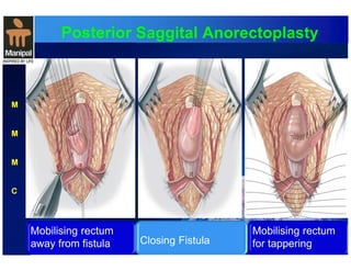 Posterior Saggital Anorectoplasty 
M 
M 
M 
C 
Mobilising rectum 
away from fistula 
Closing Fistula 
Mobilising rectum 
for tappering 
 
