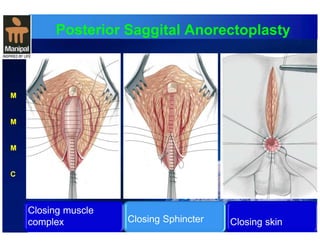 Posterior Saggital Anorectoplasty 
M 
M 
M 
C 
Closing muscle 
complex 
Closing Sphincter 
Closing skin 
 