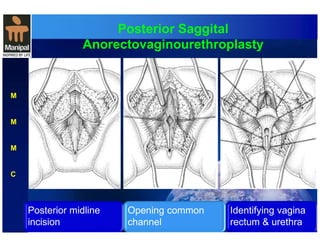 Posterior Saggital 
Anorectovaginourethroplasty 
M 
M 
M 
C 
Posterior midline 
incision 
Opening common 
channel 
Identifying vagina 
rectum & urethra 
 