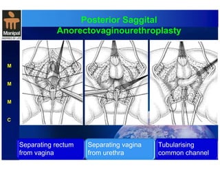 Posterior Saggital 
Anorectovaginourethroplasty 
M 
M 
M 
C 
Separating rectum 
from vagina 
Separating vagina 
from urethra 
Tubularising 
common channel 
 
