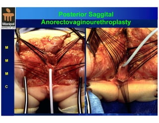 Posterior Saggital 
Anorectovaginourethroplasty 
M 
M 
M 
C 
 