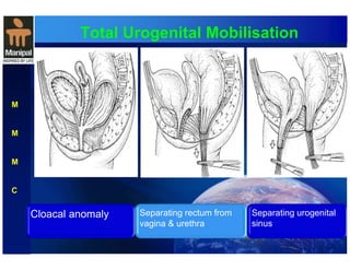 Total Urogenital Mobilisation 
M 
M 
M 
C 
Cloacal anomaly 
Separating rectum from 
vagina & urethra 
Separating urogenital 
sinus 
 