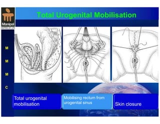 Total Urogenital Mobilisation 
M 
M 
M 
C 
Total urogenital 
mobilisation 
Mobilising rectum from 
urogenital sinus 
Skin closure 
 