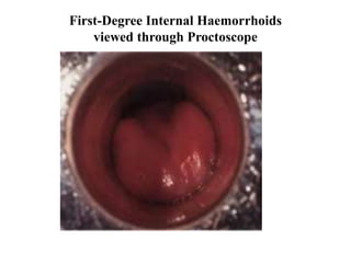 First-Degree Internal Haemorrhoids
viewed through Proctoscope
 