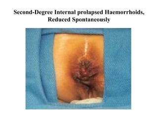 Second-Degree Internal prolapsed Haemorrhoids,
Reduced Spontaneously
 