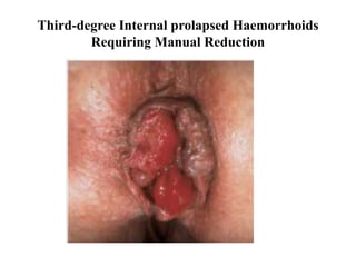 Third-degree Internal prolapsed Haemorrhoids
Requiring Manual Reduction
 