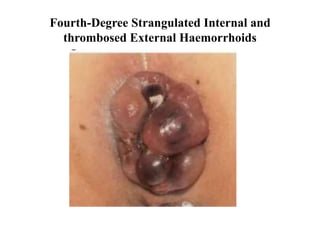 Fourth-Degree Strangulated Internal and
thrombosed External Haemorrhoids
 