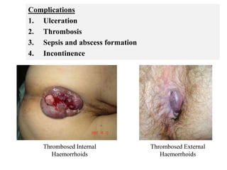 Thrombosed Internal
Haemorrhoids
Thrombosed External
Haemorrhoids
Complications
1. Ulceration
2. Thrombosis
3. Sepsis and abscess formation
4. Incontinence
 