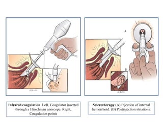 Sclerotherapy (A) Injection of internal
hemorrhoid. (B) Postinjection striations.
Infrared coagulation. Left, Coagulator inserted
through a Hirschman anoscope. Right,
Coagulation points
 