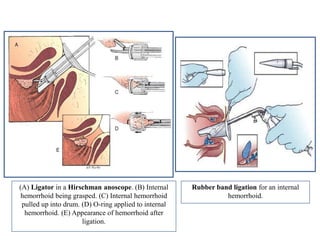 (A) Ligator in a Hirschman anoscope. (B) Internal
hemorrhoid being grasped. (C) Internal hemorrhoid
pulled up into drum. (D) O-ring applied to internal
hemorrhoid. (E) Appearance of hemorrhoid after
ligation.
Rubber band ligation for an internal
hemorrhoid.
 