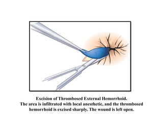 Excision of Thrombosed External Hemorrhoid.
The area is infiltrated with local anesthetic, and the thrombosed
hemorrhoid is excised sharply. The wound is left open.
 