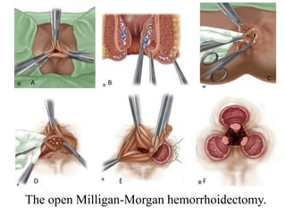 The open Milligan-Morgan hemorrhoidectomy.
A B
C
D E F
 