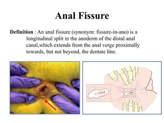 Anal Fissure
Definition : An anal fissure (synonym: fissure-in-ano) is a
longitudinal split in the anoderm of the distal anal
canal,which extends from the anal verge proximally
towards, but not beyond, the dentate line.
 