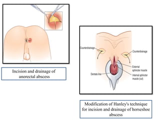 Modification of Hanley's technique
for incision and drainage of horseshoe
abscess
Incision and drainage of
anorectal abscess
 