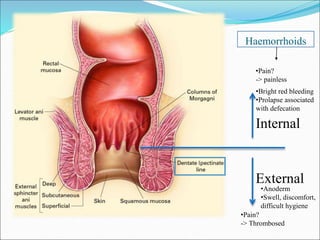 Haemorrhoids
External
Internal
•Anoderm
•Swell, discomfort,
difficult hygiene
•Pain?
-> Thrombosed
•Pain?
-> painless
•Bright red bleeding
•Prolapse associated
with defecation
 
