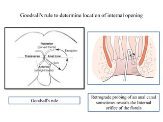 Goodsall's rule to determine location of internal opening
Retrograde probing of an anal canal
sometimes reveals the Internal
orifice of the fistula
Goodsall's rule
 