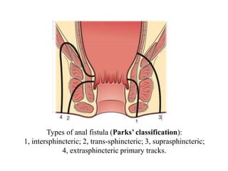 Types of anal fistula (Parks’ classification):
1, intersphincteric; 2, trans-sphincteric; 3, suprasphincteric;
4, extrasphincteric primary tracks.
 