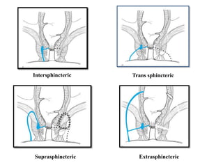 Intersphincteric
Suprasphincteric Extrasphincteric
Intersphincteric Trans sphincteric
 