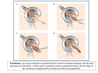 Fistulotomy. (a) A grooved probe is passed from the external to internal openings. (b) the track
laid open over the probe . (c)The track is curetted to remove granulation tissue, (d) the edges of
the wound are trimmed and the wound may then be marsupialised .
 